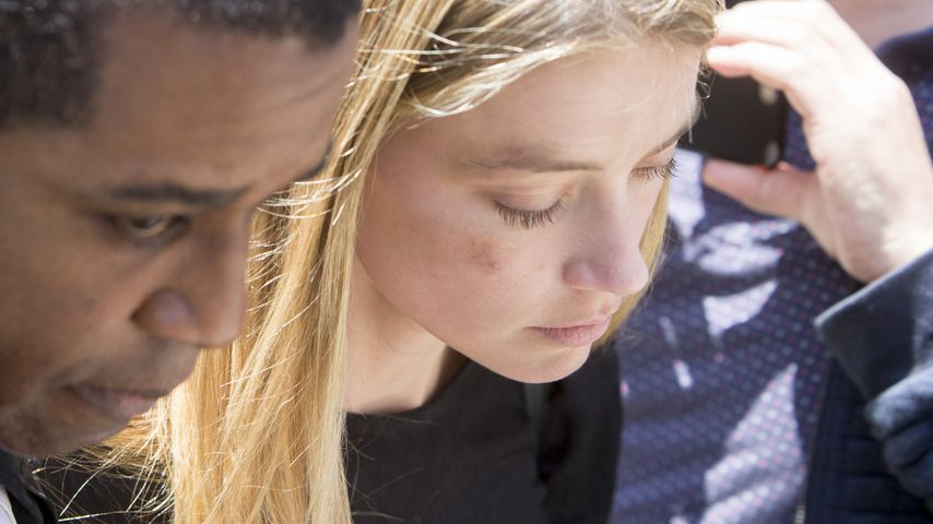 Amber Heard mit ihrer angeblich von Johnny Depp zugefügter Verletzung