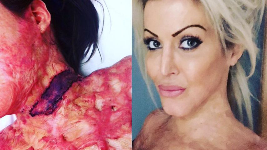 Dana Vulin: Brandopfer sieht nach 200 Operationen SO aus!