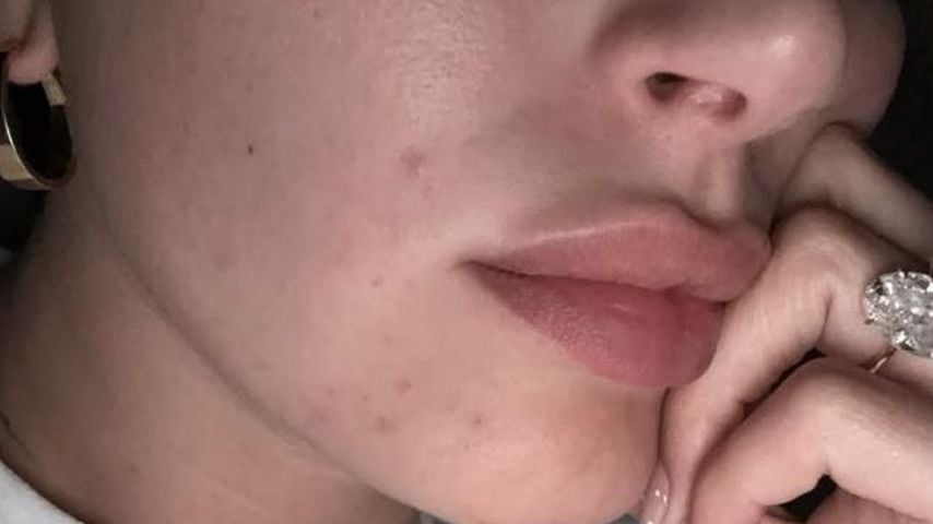 Hailey Bieber zeigt ihre periorale Dermatitis
