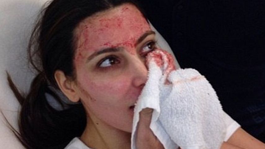 Kim Kardashian nach einem Vampir-Lifting 2013