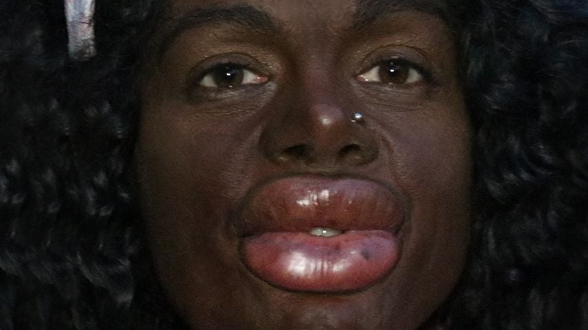 Martina Big nach ihrer Lippeninjektion im April 2025