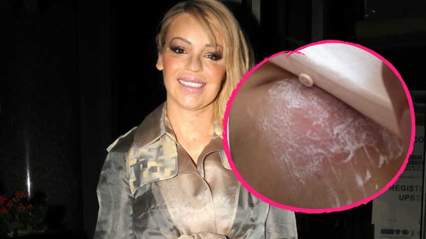 Säure-Opfer Katie Piper: Babybauch von Giftqualle gestochen!