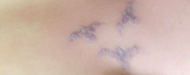 Angelina Hegers Tattoo nach der Laserbehandlung Angelina Hegers Tattoo nach der Laserbehandlung
